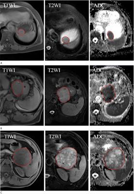 MRI-Based Radiomics Models for Predicting Risk Classification of <mark class="highlighted">Gastrointestinal Stromal Tumors</mark>